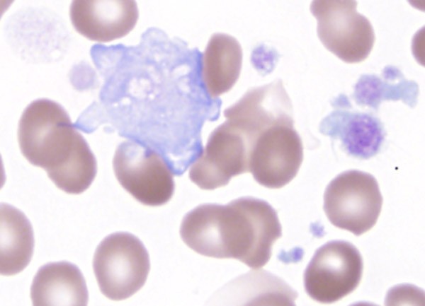 Fig 1I PB giant hypogranular platelet